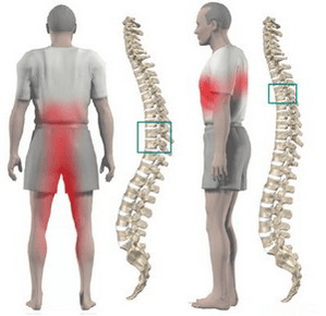 nyeri punggung pada osteochondrosis toraks