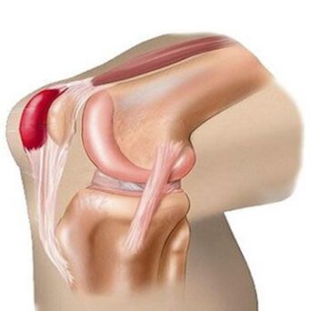 Salah satu penyebab nyeri pada sendi lutut adalah bursitis. 