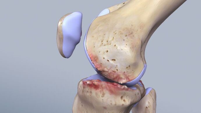 Struktur sendi lutut dipengaruhi oleh patologi
