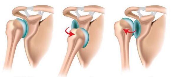 Dislokasi sendi bahu anterior dan posterior, memicu perkembangan arthrosis