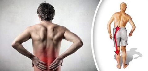 Sindrom nyeri dengan osteokondrosis lumbar memancar ke kaki
