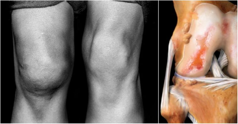 Arthrosis sendi lutut dan sendi sakit