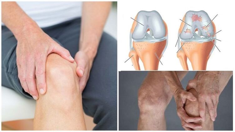 Gejala nyeri lutut arthrosis sendi lutut