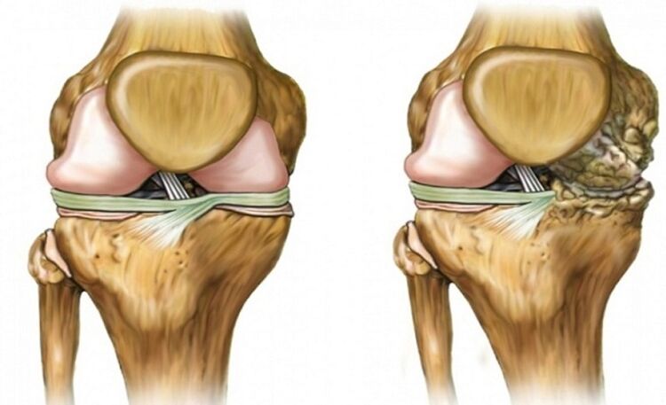 Sehat dan terpengaruh oleh sendi arthrosis