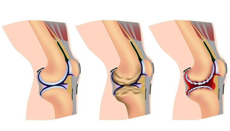 Tahapan deformasi pada sendi lutut untuk arthrosis
