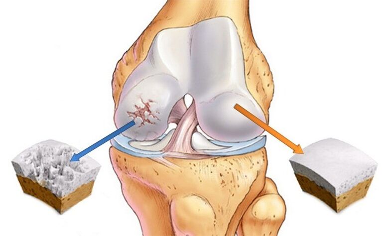 Tulang rawan normal dan dipengaruhi oleh arthrosis