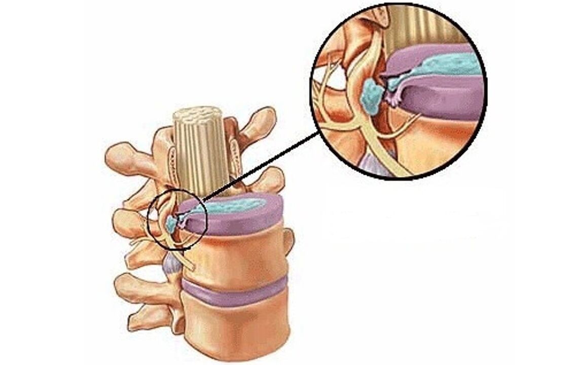 hernia intervertebralis dengan osteochondrosis toraks