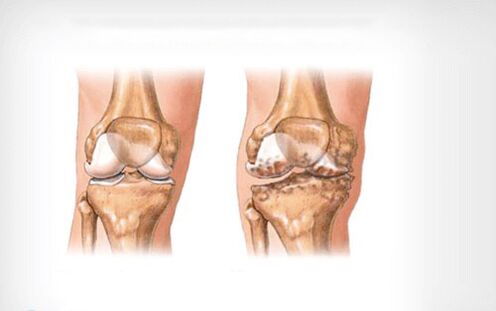 arthrosis sendi lutut