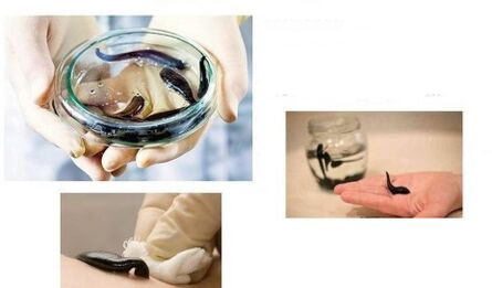 hirudoterapi untuk arthrosis