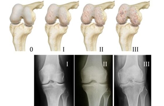 metode untuk mendiagnosis arthrosis lutut