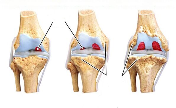 tahap arthrosis lutut